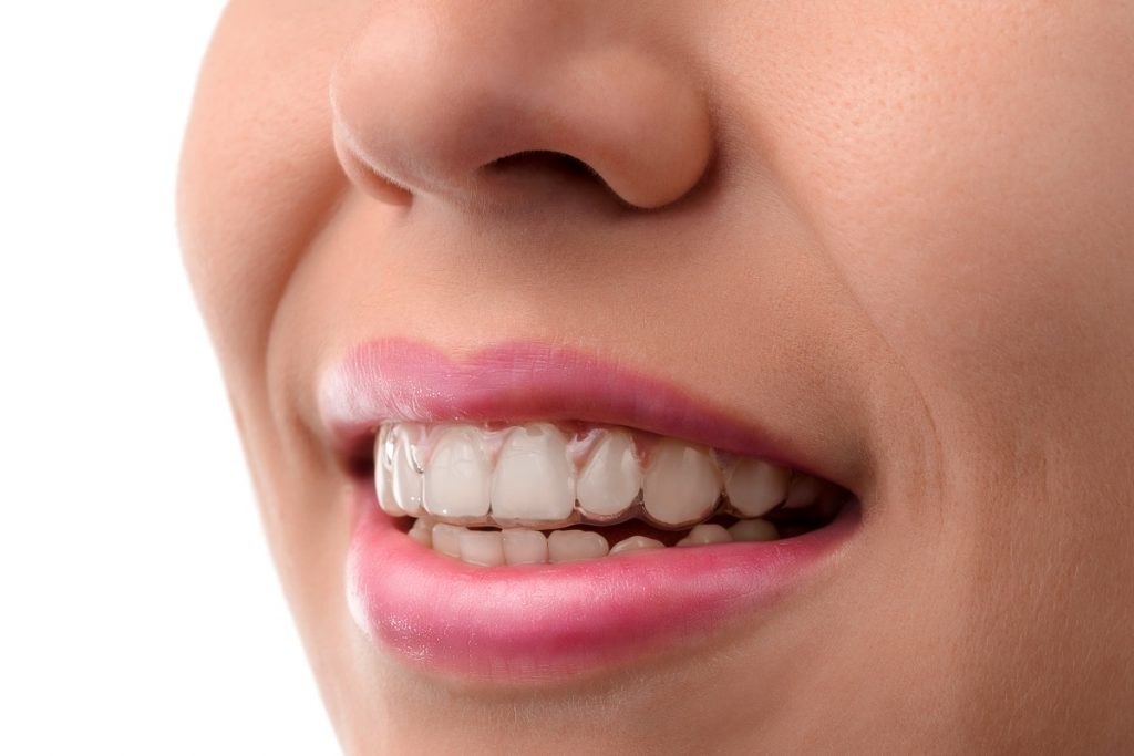 woman wearing invisible aligners
