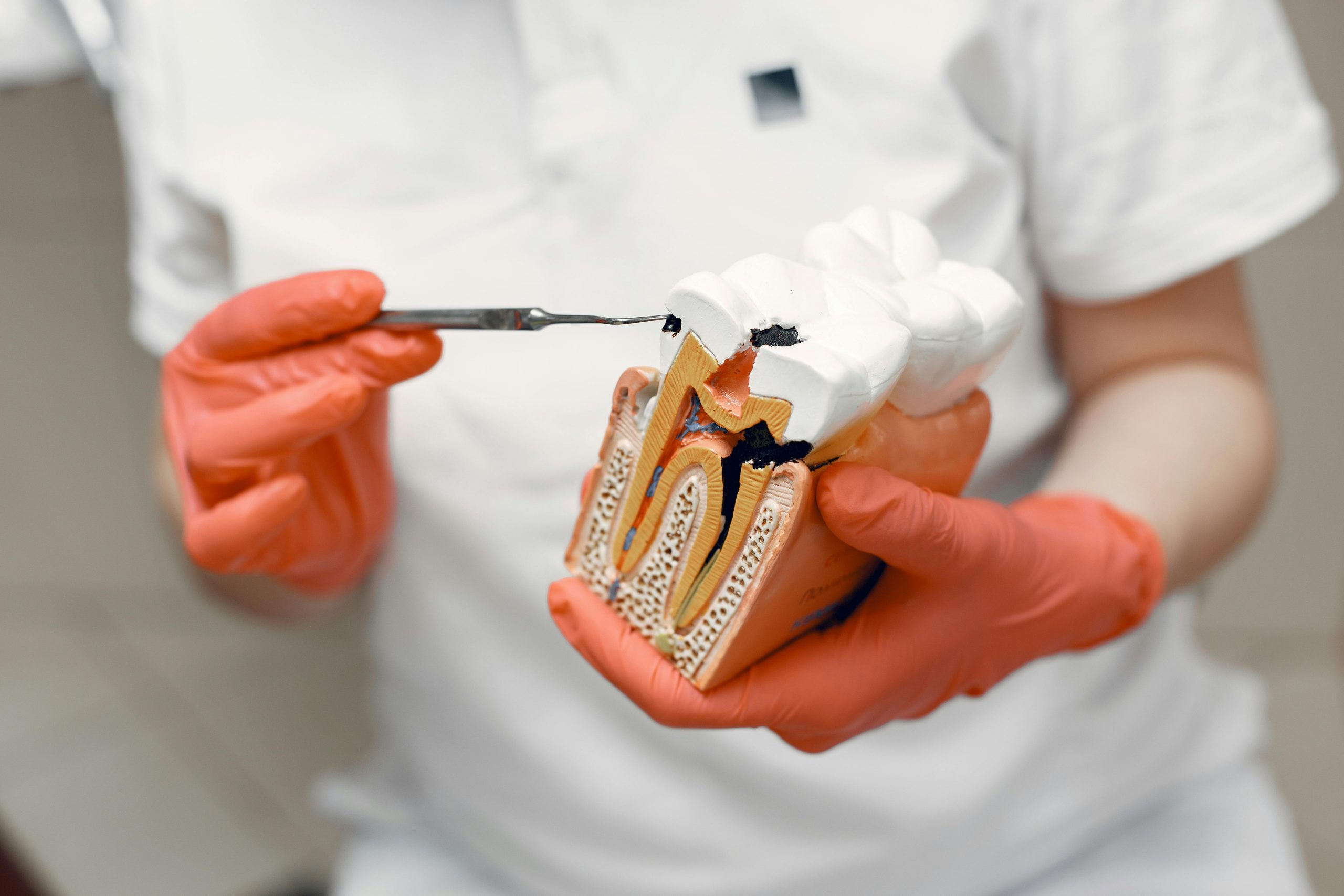 dentist pointing at a cavity on a tooth model using a sickle probe